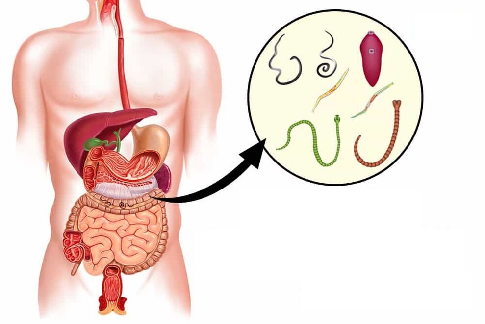 Würmer im menschlichen Darm